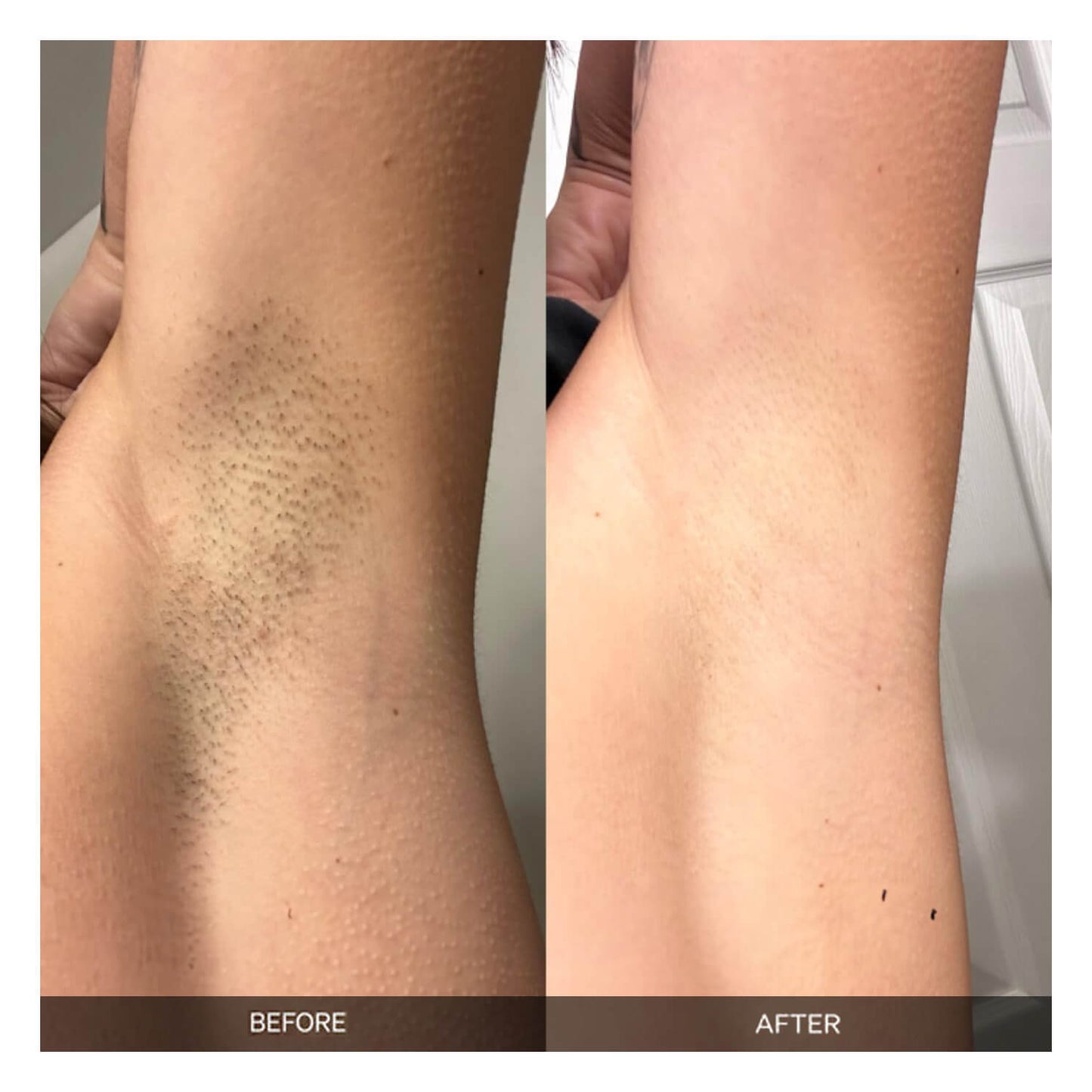 Laser Hair Removal