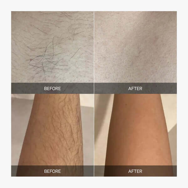 Laser Hair Removal